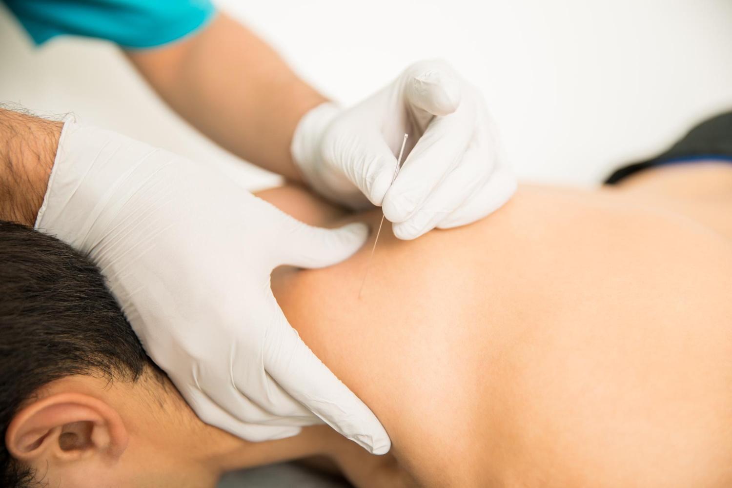 Fysiotherapeut helpt man behandelen met dry needling bij terugkerende spierklachten.